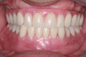 Why Implant-Supported Dentures Are Better Than Regular Dentures